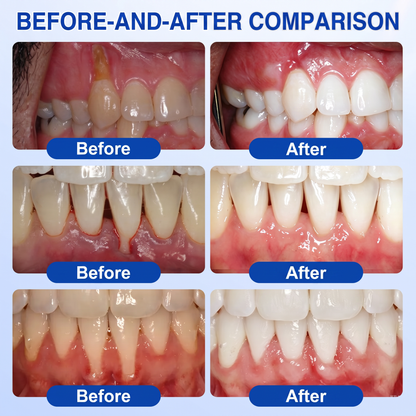 🇨🇦Pureluxo® 🦷GumRevive periodontal repair gel🌿