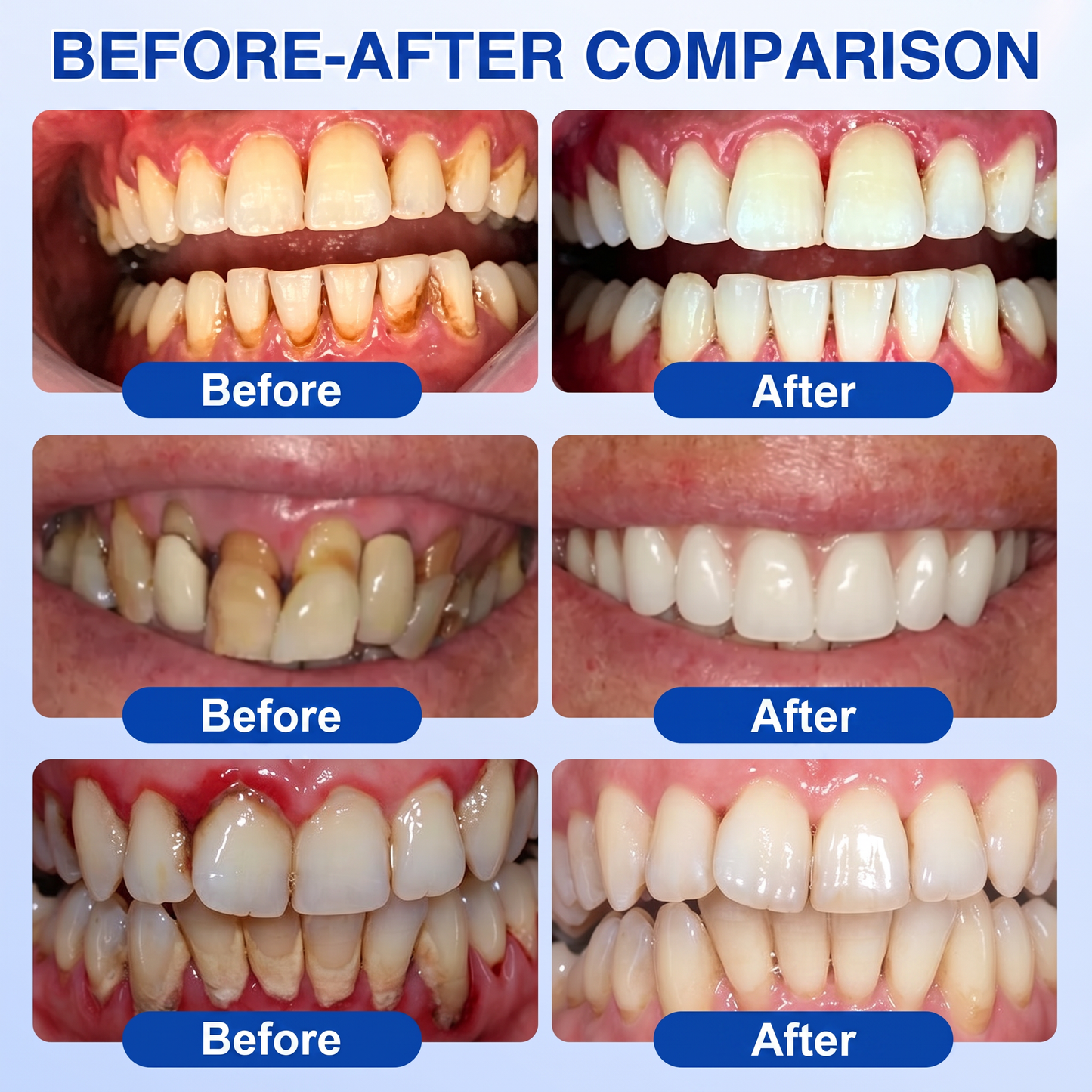 🇨🇦Pureluxo® 🦷GumRevive periodontal repair gel🌿