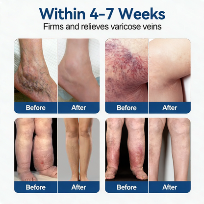 𝐏𝐮𝐫𝐞𝐥𝐮𝐱𝐨® 𝗩𝗲𝒊𝒏 𝐂𝒐𝒏𝘁𝗼𝐮𝐫 𝐌𝐢𝐜𝐫𝐨𝒏𝒆𝒆𝒅𝗹𝗲 𝑷𝒂𝒕𝐜𝐡 (𝐉𝐮𝐬𝐭 𝐎𝐧𝐜𝐞 𝐀 𝐃𝐚𝐲, 𝐒𝐞𝐞 𝐑𝐞𝐬𝐮𝐥𝐭𝐬 𝐈𝐧 𝟕 𝐃𝐚𝐲𝐬) — 👩‍⚕️🏆 𝐒𝐮𝐢𝐭𝐚𝐛𝐥𝐞 𝐅𝐨𝐫 𝐕𝐚𝐫𝐢𝐜𝐨𝐬𝐞 𝐕𝐞𝐢𝐧𝐬 𝐀𝐧𝐝 𝐒𝐩𝐢𝐝𝐞𝐫 𝐕𝐞𝐢𝐧𝐬, 𝐑𝐞𝐥𝐢𝐞𝐯𝐞𝐬 𝐇𝐞𝐚𝐯𝐲, 𝐓𝐢𝐫𝐞𝐝 𝐋𝐞𝐠🛒