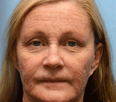 (Made and Shipped from CAN) 🧑‍⚕️TLOPA® Botox Bee Venom Wrinkle Removal Cream- LAST DAY 70% OFF🔥