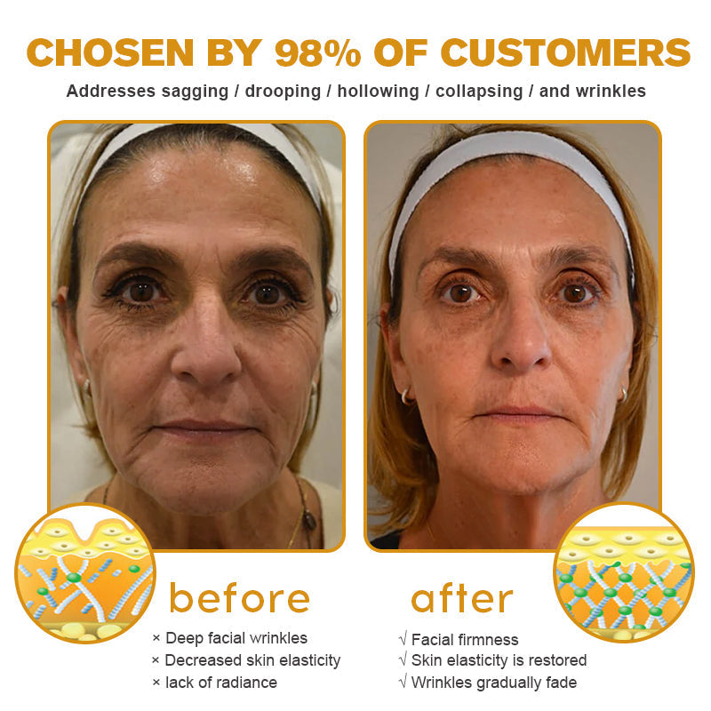 (Made and Shipped from CAN) 🧑‍⚕️TLOPA® Botox Bee Venom Wrinkle Removal Cream- LAST DAY 70% OFF🔥